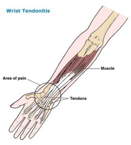 wrist tendonitis