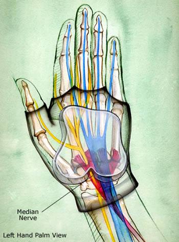 gel pad median nerve