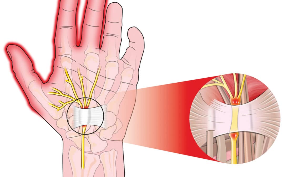 Carpal Tunnel Syndrome